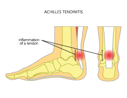 Easy Achilles Tendon Stretches for Tight Calves - Vive Health