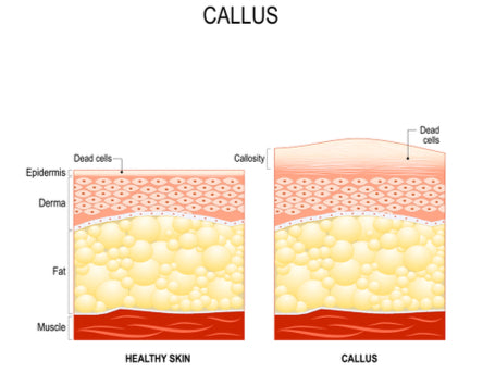 Callousous Calluses on the Feet Causes and Treatment – Insoles.com