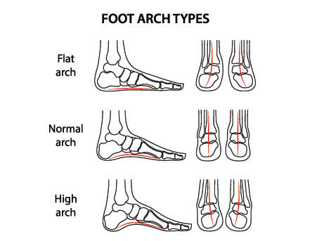 Fallen Arches Symptoms and Treatment – Insoles.com