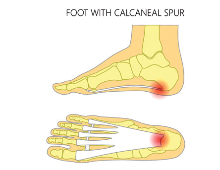Symptoms and Conditions - Heel Spurs – DrScholls
