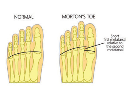 Morton's Toe Spiritual Meaning: A Guide to Its Mystique 2 Morton's Toe