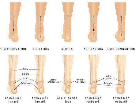 Underpronation, Supinated and High Arched Foot